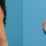 Breast Implant #23 - Before and After