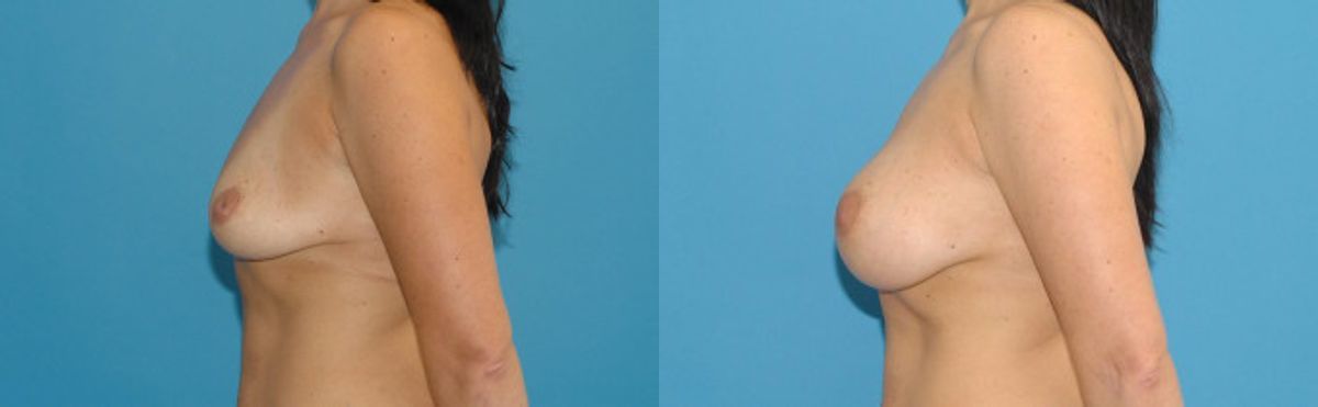 Breast Implant #23 - Before and After