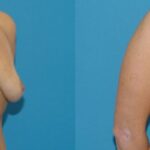 Breast Implant #23 - Before and After