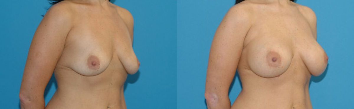 Breast Implant #23 - Before and After