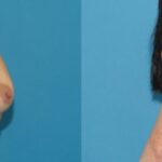 Breast Implant #23 - Before and After