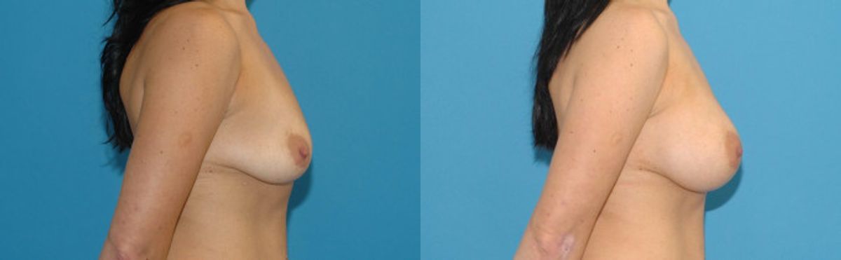 Breast Implant #23 - Before and After