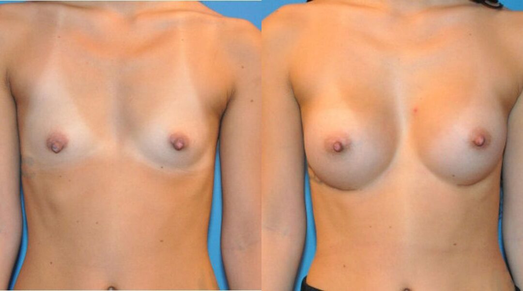 Breast Implant #24