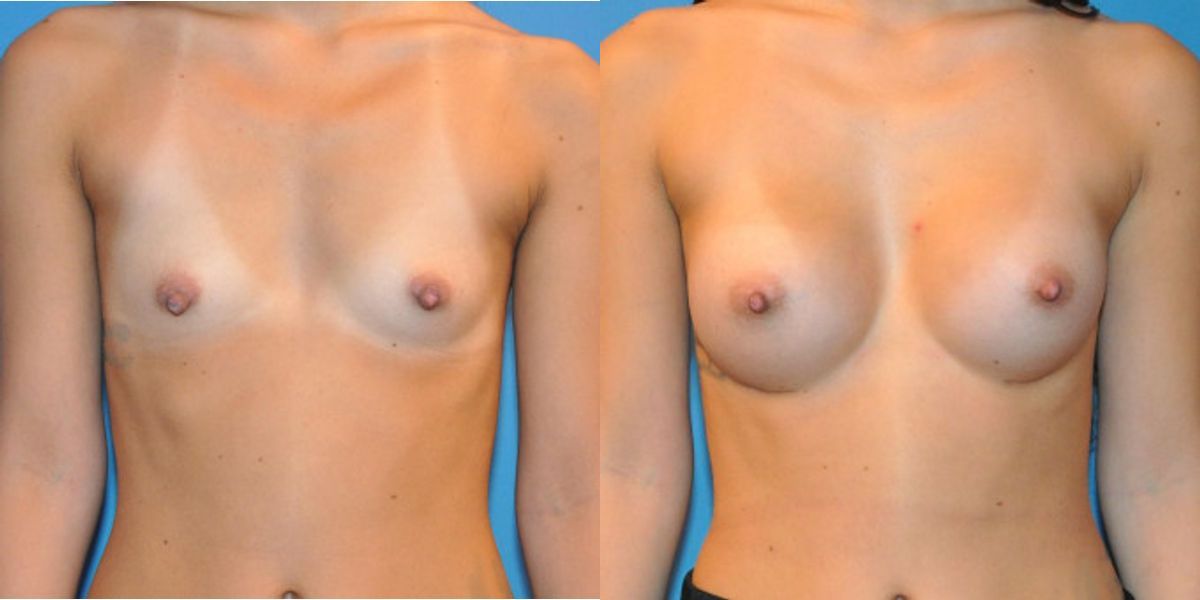 Breast Implant #24 - Before and After