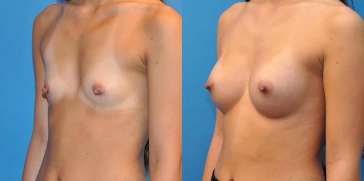 Breast Implant #24 - Before and After