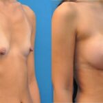 Breast Implant #24 - Before and After