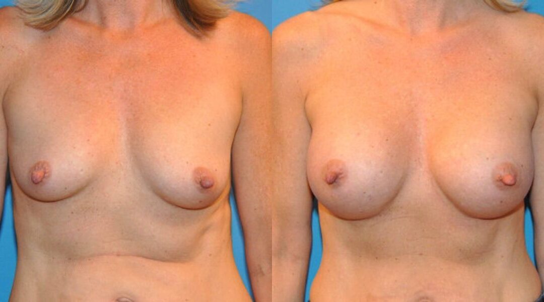 Breast Implant #25