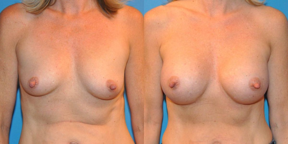 Breast Implant #25 - Before and After