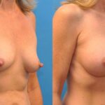 Breast Implant #25 - Before and After