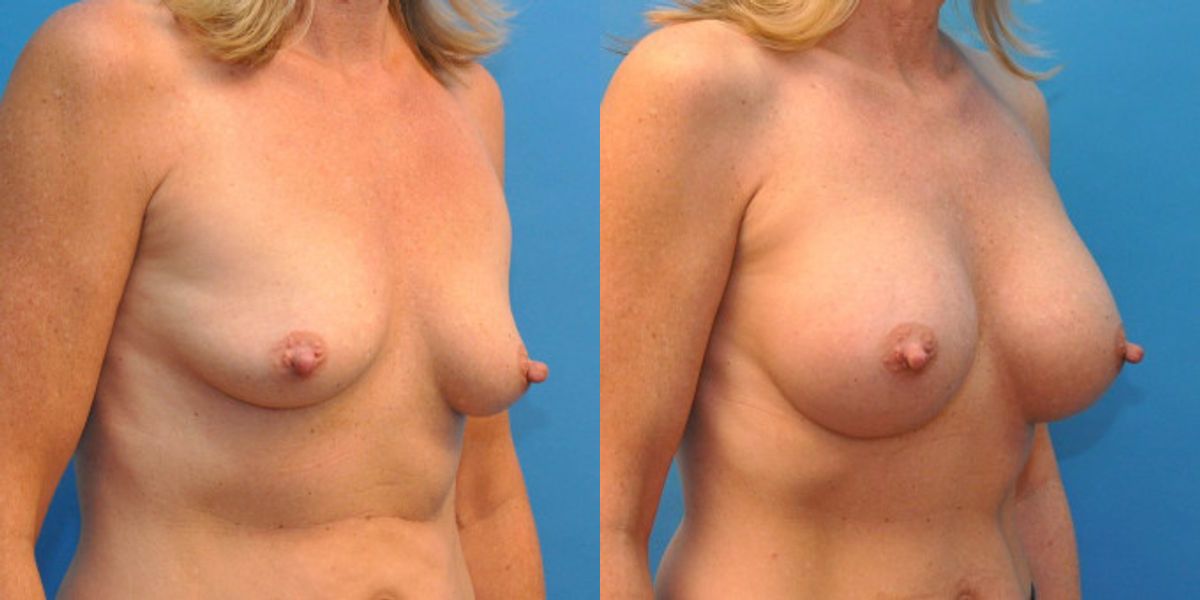 Breast Implant #25 - Before and After