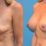 Breast Implant #25 - Before and After