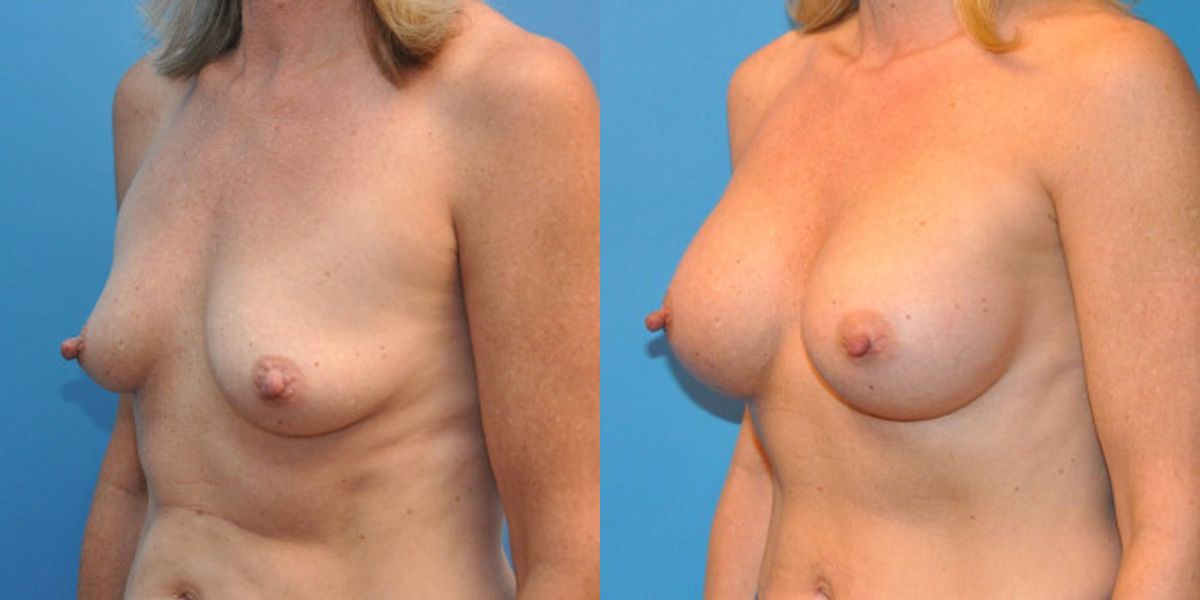 Breast Implant #25 - Before and After