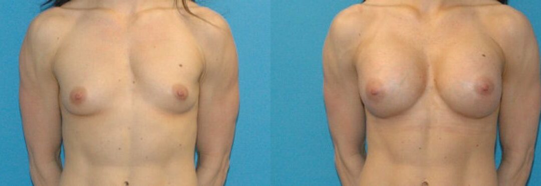 Breast Implant #26