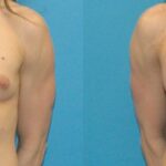 Breast Implant #26 - Before and After