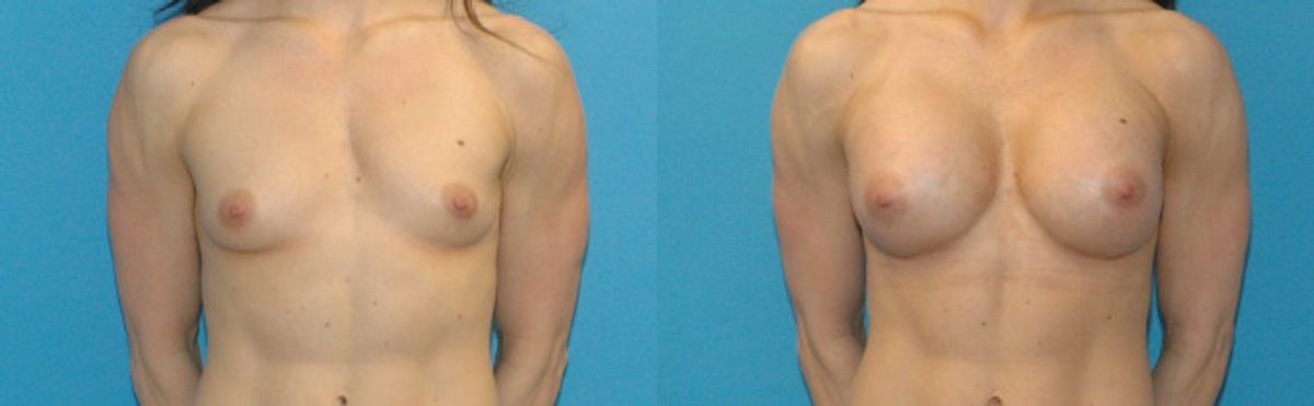 Breast Implant #26 - Before and After