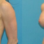 Breast Implant #26 - Before and After