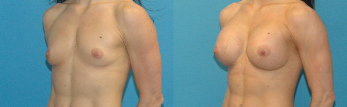 Breast Implant #26 - Before and After