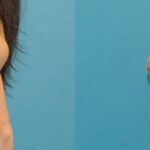 Breast Implant #26 - Before and After