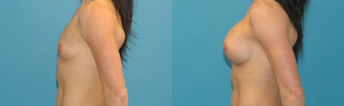 Breast Implant #26 - Before and After