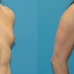 Breast Implant #26 - Before and After