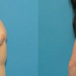 Breast Implant #26 - Before and After