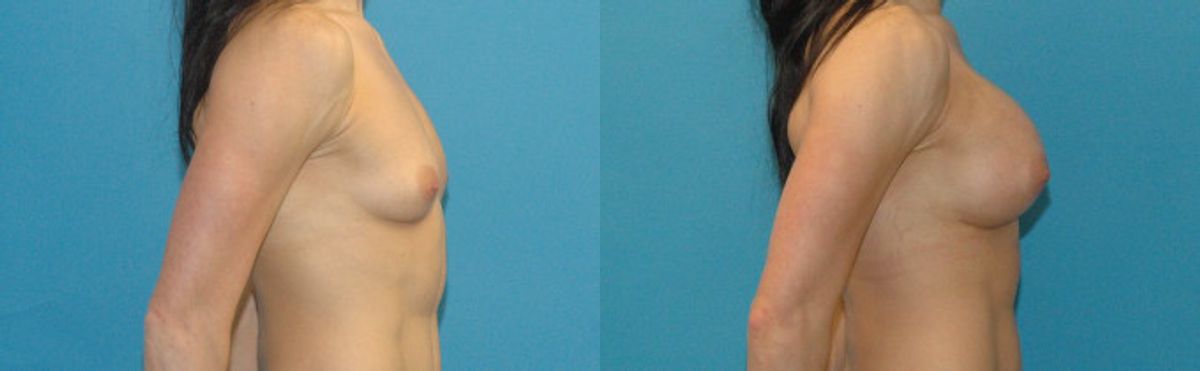 Breast Implant #26 - Before and After