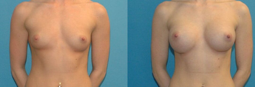Breast Implant #27
