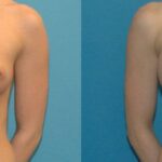 Breast Implant #27 - Before and After