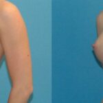 Breast Implant #27 - Before and After