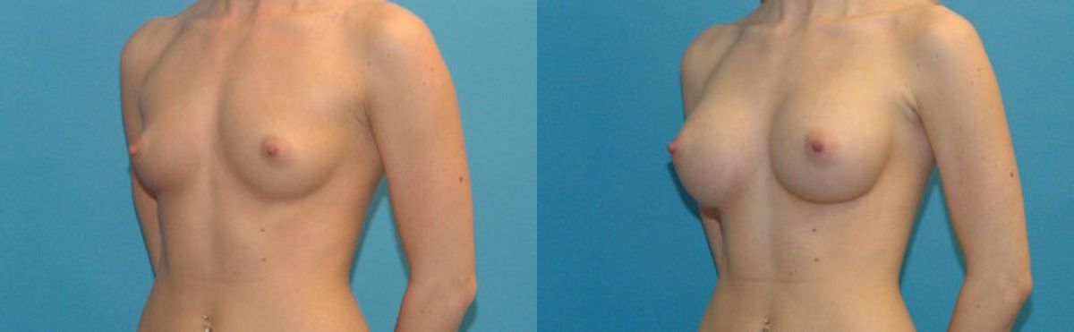 Breast Implant #27 - Before and After