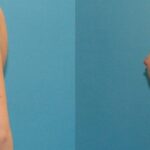 Breast Implant #27 - Before and After