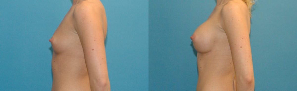Breast Implant #27 - Before and After