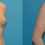 Breast Implant #27 - Before and After