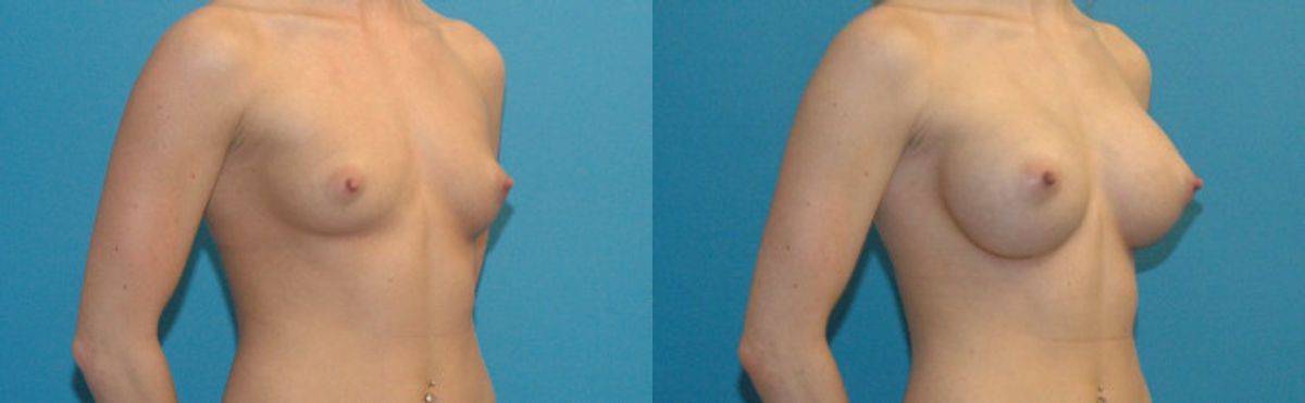 Breast Implant #27 - Before and After