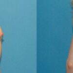 Breast Implant #27 - Before and After