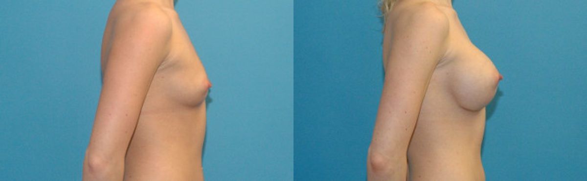 Breast Implant #27 - Before and After