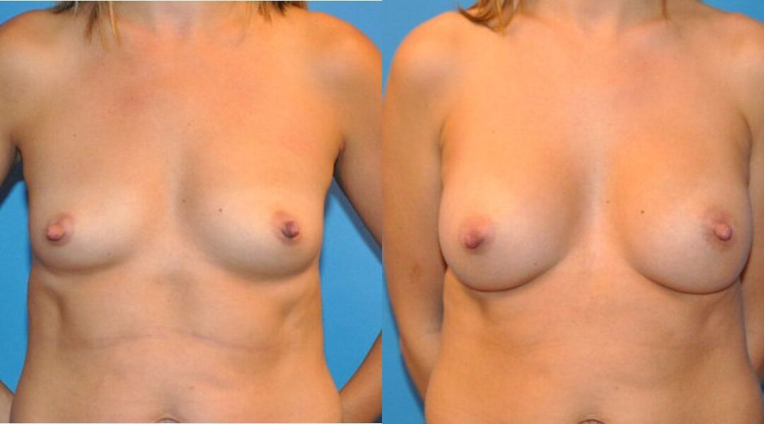 Breast Implant #28