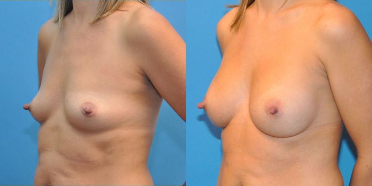 Breast Implant #28 - Before and After