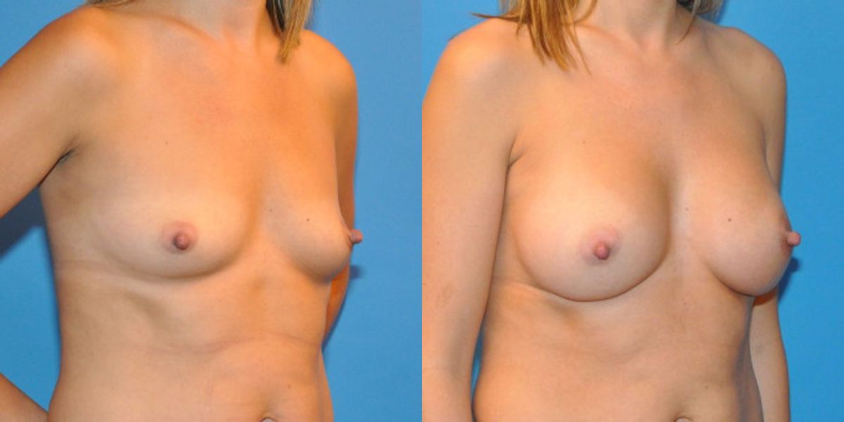 Breast Implant #28 - Before and After