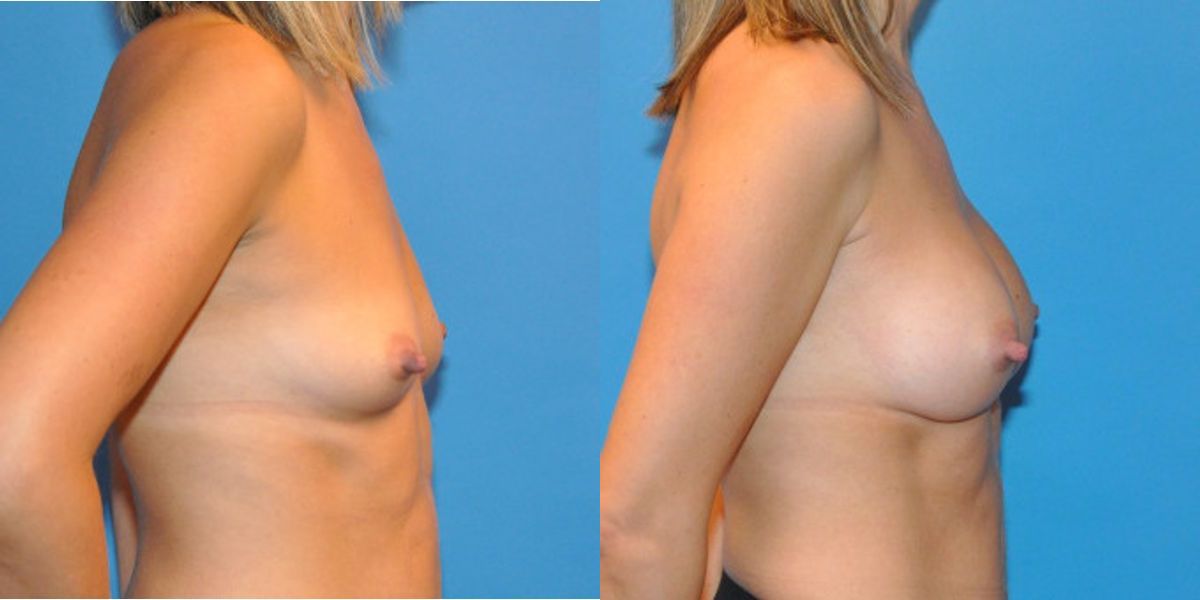 Breast Implant #28 - Before and After