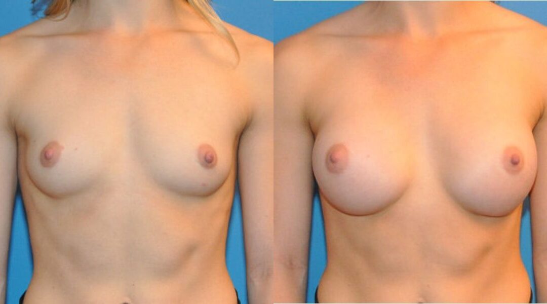 Breast Implant #29