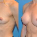 Breast Implant #29 - Before and After