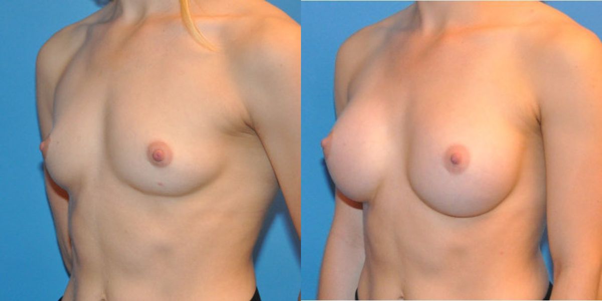 Breast Implant #29 - Before and After