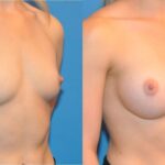 Breast Implant #29 - Before and After