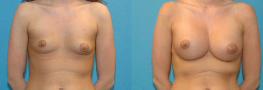 Breast Implant #30