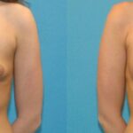 Breast Implant #30 - Before and After