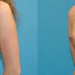 Breast Implant #30 - Before and After