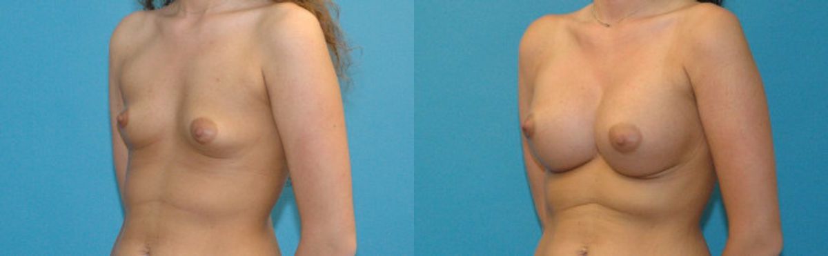 Breast Implant #30 - Before and After