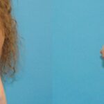 Breast Implant #30 - Before and After