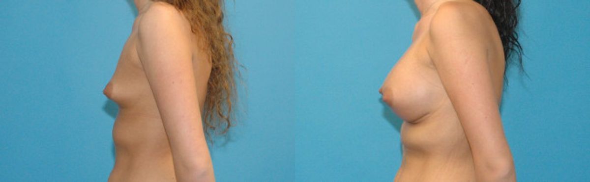 Breast Implant #30 - Before and After